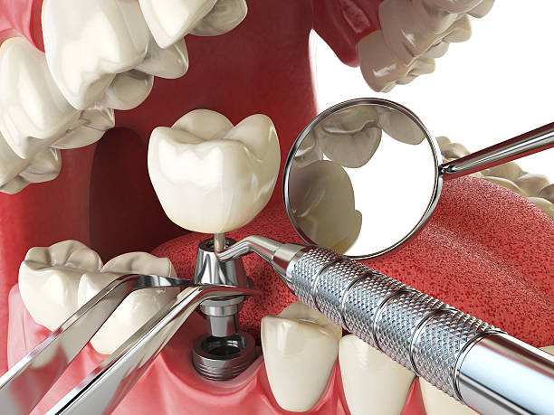 Best Broken or Chipped Tooth Repair in Madisonville, TX