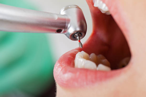 Best Dental Abscess Treatment in Madisonville, TX